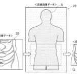 【特許紹介】患者の体表面にプロジェクションマッピングされる臓器の歪みをおさえる特許発明(富士フイルム)